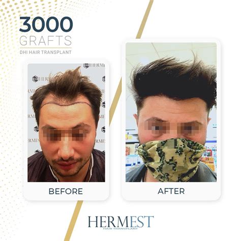 Hermest Hair Transplant 